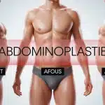 abdominoplastie avant après : silhouette avant après après 12 mois