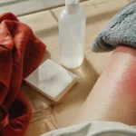 Comment faire dérougir un coup de soleil : compresse froide et hydratation